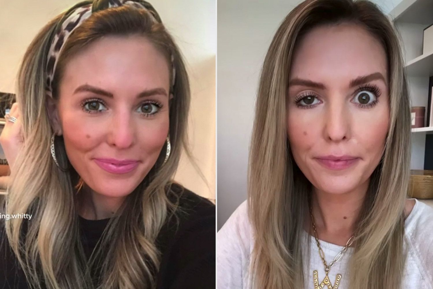 Influencer Candidly Reveals What Happens When Botox Goes Wrong